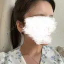 脂肪注入（額） 4Dクリニック DAY 5 サムネイル用