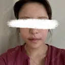 脂肪注入（額） 4Dクリニック DAY 14 サムネイル用