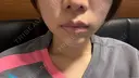 ヒアルロン酸注入（あご） 新未来クリニック AFTER サムネイル用