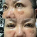クマ治療 PRISM Beauty Clinic 町田院 DAY 11 サムネイル用