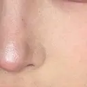 ピーリング（ニキビ・毛穴） HAAB CLINIC 池袋院 AFTER サムネイル用