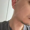 糸リフト / ボトックス（エラ・小顔） Tokyo Tensei Clinic 新宿院 DAY 31 サムネイル用