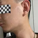 糸リフト / ボトックス（エラ・小顔） Tokyo Tensei Clinic 新宿院 DAY 31 サムネイル用