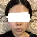 糸リフト / バッカルファット除去 / 脂肪吸引（顔） / ネックリフト / ヒアルロン酸注入（あご） / ボトックス（エラ・小顔） / ヒアルロン酸注入（唇） / ヒアルロン酸注入（鼻翼基部） / ヒアルロン酸注入（ほうれい線） HAAB×DREAM BEAUTY CLINIC 東京本院 DAY 14 サムネイル用