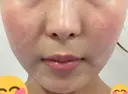その他（輪郭） / 医療痩身（顔） / その他（肌） / RF（高周波）たるみ治療 / オンダリフト ライブリークリニック 船橋院 DAY 5 サムネイル用