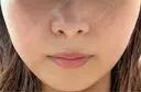 その他（輪郭） / 医療痩身（顔） / その他（肌） / RF（高周波）たるみ治療 / オンダリフト ライブリークリニック 船橋院 DAY 6 サムネイル用