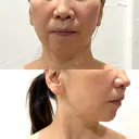 ハイフ（顔） / ボルニューマ LIFE LAB CLINIC DAY 33 サムネイル用