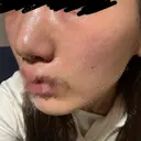 肌育注射（ジュベルックなど） Natural Skin Clinic 自由ヶ丘院 DAY 0 サムネイル用