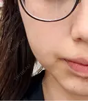 水光注射（ハリ・美肌） メディアージュクリニック 大阪梅田院 DAY 1 サムネイル用