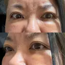 クマ治療 PRISM Beauty Clinic 町田院 DAY 17 サムネイル用