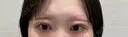 二重埋没 R Beauty CLINIC 名古屋院 AFTER サムネイル用