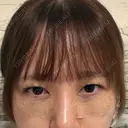下まぶたの脂肪取り 聖心美容クリニック 福岡院 DAY 0 サムネイル用