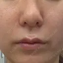 ボトックス（あご） / ヒアルロン酸注入（鼻翼基部） DMTC美容皮膚科 大宮院 AFTER サムネイル用