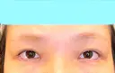 目尻切開 / タレ目形成・グラマラスライン（埋没） LOUIS CLINIC 二子玉川院【ルイクリニック】 DAY 0 サムネイル用