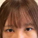 下まぶたの脂肪取り 聖心美容クリニック 福岡院 DAY 2 サムネイル用