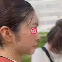 糸リフト / ボトックス（あご） / ヒアルロン酸注入（あご） / ボトックス（エラ・小顔） / ヒアルロン酸注入（唇） / ボトックス（口角） / ヒアルロン酸注入（額） / ヒアルロン酸注入（頬） / ヒアルロン酸注入（目の下） / ボトックス（眉間） / ボトックス（額） / ボトックス（人中） / ヒアルロン酸注入（鼻翼基部） EMMO FACE CLINIC 大宮院 AFTER サムネイル用
