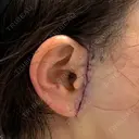 切開リフト GRACY TOKYO CLINIC【グレイシートウキョウクリニック】 DAY 0 サムネイル用