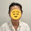 切開リフト GRACY TOKYO CLINIC【グレイシートウキョウクリニック】 DAY 0 サムネイル用
