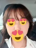 水光注射（ハリ・美肌） メディアージュクリニック 大阪梅田院 AFTER サムネイル用