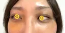 糸リフト / クマ治療 / 脂肪吸引（顔） / 下まぶたの脂肪取り / 脂肪注入（目の下） / ヒアルロン酸注入（あご） 藤・ナチュレ美容クリニック 銀座院 DAY 4 サムネイル用