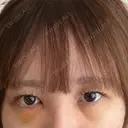 下まぶたの脂肪取り 聖心美容クリニック 福岡院 DAY 3 サムネイル用