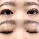 二重埋没 湘南美容クリニック 博多院 DAY 6 サムネイル用