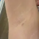 ワキ汗治療（ボトックス） DMTC CLINIC 渋谷院 DAY 3 サムネイル用