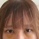 下まぶたの脂肪取り 聖心美容クリニック 福岡院 DAY 4 サムネイル用
