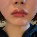 ヒアルロン酸注入（あご） / ヒアルロン酸注入（唇） 麻布十番クレールデンタルクリニック DAY 0 サムネイル用