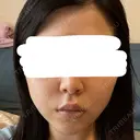 糸リフト / バッカルファット除去 / 脂肪吸引（顔） / ネックリフト / ヒアルロン酸注入（あご） / ボトックス（エラ・小顔） / ヒアルロン酸注入（唇） / ヒアルロン酸注入（鼻翼基部） / ヒアルロン酸注入（ほうれい線） HAAB×DREAM BEAUTY CLINIC 東京本院 DAY 21 サムネイル用
