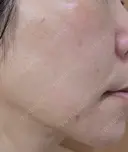 肌育注射（ジュベルックなど） メディアージュクリニック 名古屋院 DAY 2 サムネイル用