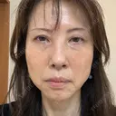 クマ治療 NARU Beauty Clinic 【ナルクリ】 AFTER サムネイル用
