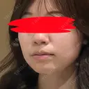 糸リフト / 脂肪吸引（顔） / 脂肪吸引注射（顔） SEA CLINIC（シークリニック） DAY 0 サムネイル用