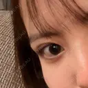 二重埋没 水の森美容クリニック 横浜院 DAY 43 サムネイル用