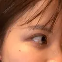 二重埋没 水の森美容クリニック 横浜院 DAY 43 サムネイル用
