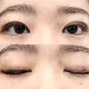 二重埋没 湘南美容クリニック 博多院 DAY 8 サムネイル用