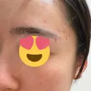 ピーリング（ニキビ・毛穴） 大美会クリニック 心斎橋本院 AFTER サムネイル用