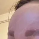 前額リフト / ボトックス（額） WOM CLINIC GINZA （ワム クリニック ギンザ） AFTER サムネイル用