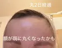 前額リフト / ボトックス（額） WOM CLINIC GINZA （ワム クリニック ギンザ） DAY 2 サムネイル用