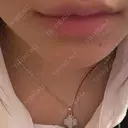 ヒアルロン酸注入（涙袋） / ヒアルロン酸注入（あご） / ヒアルロン酸注入（唇） 麻布十番クレールデンタルクリニック DAY 0 サムネイル用