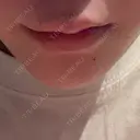 ヒアルロン酸注入（涙袋） / ヒアルロン酸注入（あご） / ヒアルロン酸注入（唇） 麻布十番クレールデンタルクリニック DAY 1 サムネイル用