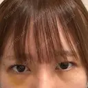 下まぶたの脂肪取り 聖心美容クリニック 福岡院 DAY 6 サムネイル用