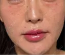 リジュラン 麻布十番クレールデンタルクリニック DAY 0 サムネイル用