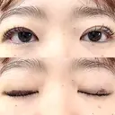 二重埋没 湘南美容クリニック 博多院 DAY 9 サムネイル用