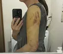 脂肪吸引（二の腕） / 豊胸（脂肪注入） / 脂肪吸引（肩） Lipo Clinic omotesando DAY 3 サムネイル用