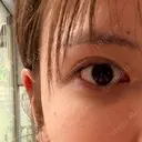 二重埋没 水の森美容クリニック 横浜院 DAY 45 サムネイル用