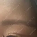 眉下切開 PRO CLINIC プロクリニック 銀座院 AFTER サムネイル用