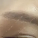 眉下切開 PRO CLINIC プロクリニック 銀座院 DAY 402 サムネイル用