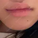 ヒアルロン酸注入（涙袋） / ヒアルロン酸注入（あご） / ヒアルロン酸注入（唇） 麻布十番クレールデンタルクリニック DAY 2 サムネイル用