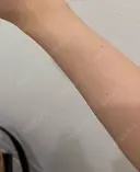 白玉点滴・注射 Aya Beauty & Family Clinic大阪院 AFTER サムネイル用